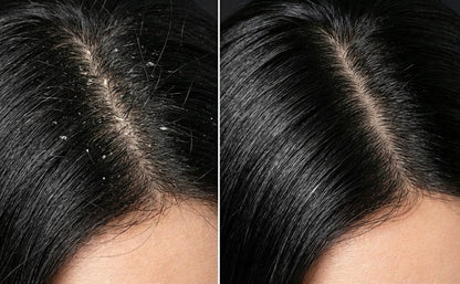 Shampoo Anticaspa y Purificante con Carbón Activado