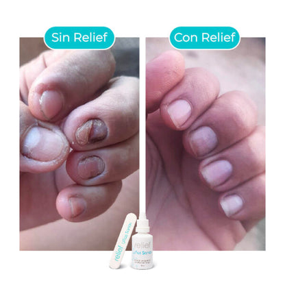 Gotas para hongos en las uñas