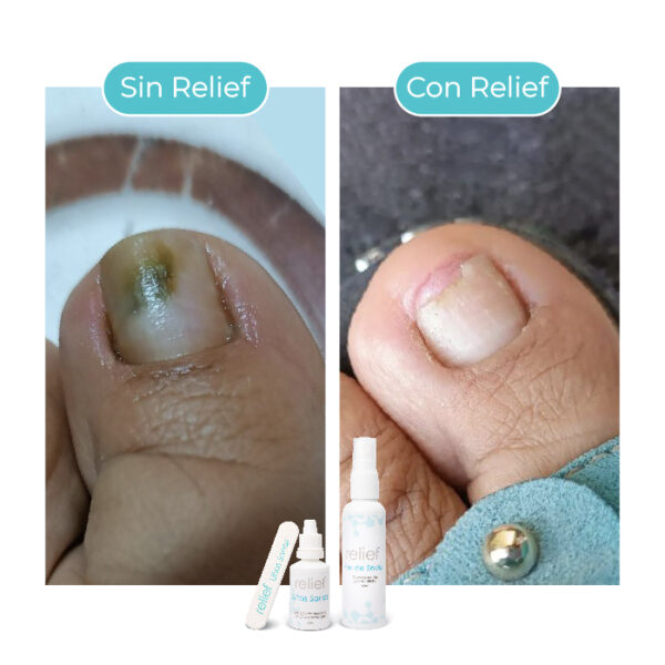 Gotas para hongos en las uñas