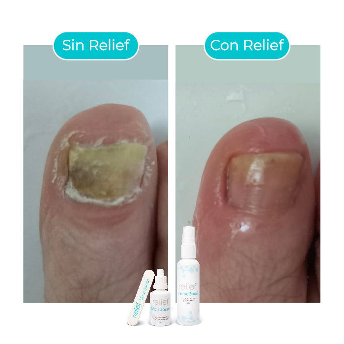 Gotas para hongos en las uñas