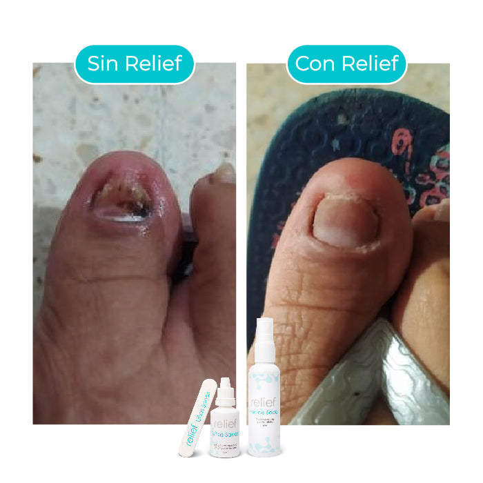 Gotas para hongos en las uñas